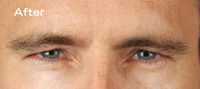 Frown / Glabellar Lines correct with Botox